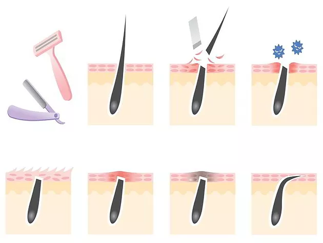 10 Tips To Prevent Ingrown Hair