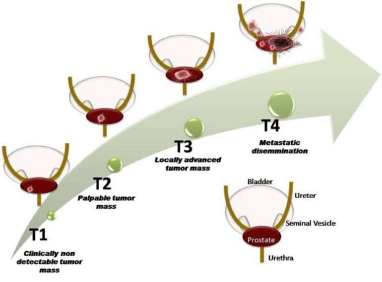 Prostate Cancer Stages