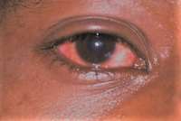 Washing 'Apollo' infected eyes with seawater is inappropriate - Optometrist