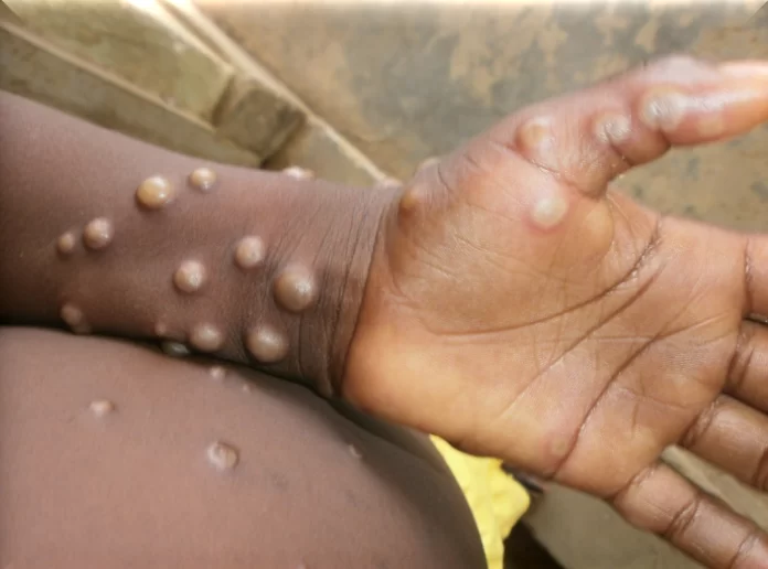 GHS confirms four new Mpox cases, national tally hits 1,062