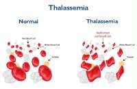 Understanding Thalassemia: Causes, Treatment, and the Importance of Awareness