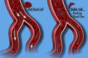 Sickle cell disease: know your status!