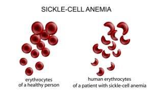 Sickle Cell Foundation Of Ghana, Novartis Deploy Mobile Digital Solution To Support Newborn Screening For Sickle Cell Disease