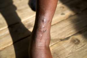 Doctors use the scars to piece together what happened to the migrants.  By Alexandros Kottis (AFP)