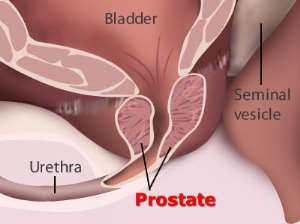 prostate cancer 0