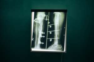 An X-ray of a wounded Congolese soldier's leg. By ALEXIS HUGUET AFP