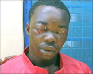 Robber shot in eyeball