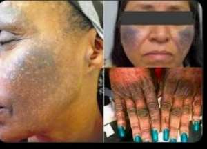 Poison for Sale: How Social Media Is Turning Nigerias Skincare Craze into a Public Health Hazard