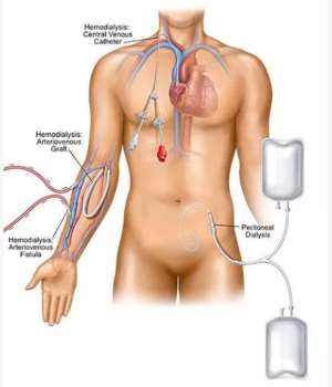 Herbal Concoctions and Dehydration Are Fuelling Kidney Disease, Experts Warn