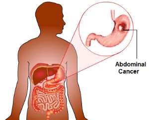 Abdominal Cancers