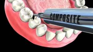 Check Out Drug That Re-grows Tooth And Seals Cavities