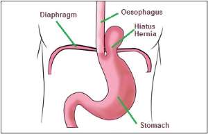 Hiatal Hernia