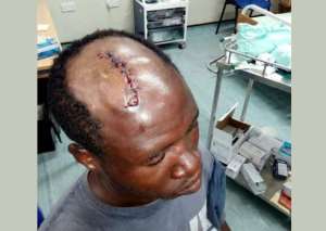 One of the workers who had surgery on his head as a result of injury he sustained from the workers.