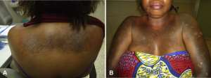 The damage bleaching can cause to the body