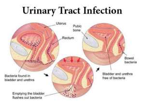 Unattended urinary tract infection can cause serious kidney damage