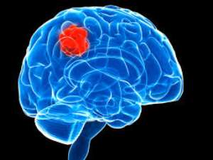Breaking New Ground: Innovations in brain tumor research