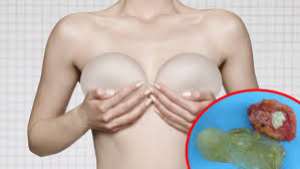 Effects Of Breast Implants – Study Reveals