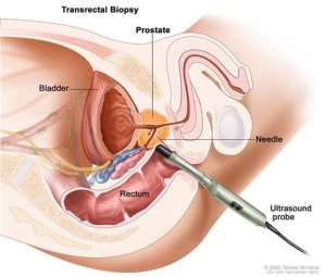 Prostate Cancer:  After Biopsy; what does it mean?