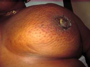 No traditional medicine or herbs can cure breast cancer; i''ve tried it all and here i'm — Patient reveals