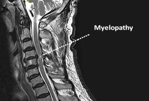 Understanding Cervical Myelopathy: A Neurosurgeons Insight