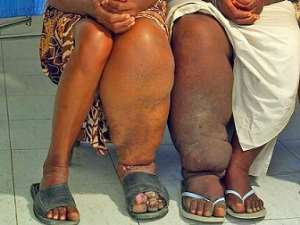 Two female elephantiasis patients in Africa