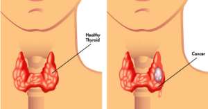 The Gland That Rules Your Body: A Guide to Thyroid Wellness and Cancer Detection