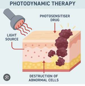 Photodynamic Therapy: A Game-Changer in Combating Bacterial Infections and Cancer in Ghana