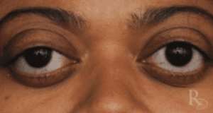 Bulging Eyes Could Be A Sign Of Serious Medical Condition  Not Beauty
