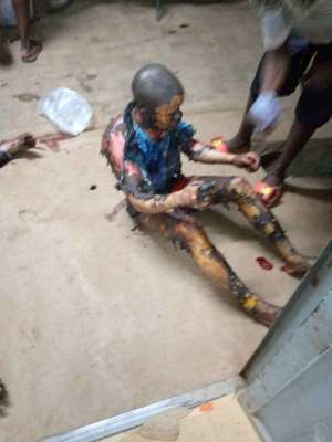 Victim of petrol tank explosion in Freetown, Sierra Leone Photo credit: Joel Savage
