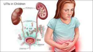 A medical illustration of the kidneys ureters bladder and urethra with E. coli in the background and a young girl holding her belly and looking distressed illustrating UTIs in children original