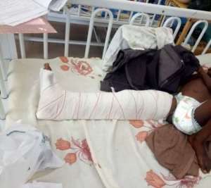 UER Hospital Records High Cases Of Fractures In children