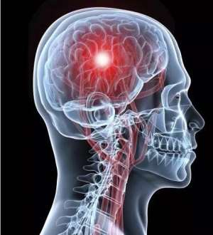 T.I.A. What Is A Transient Ischemic Attack or Mini-Stroke?