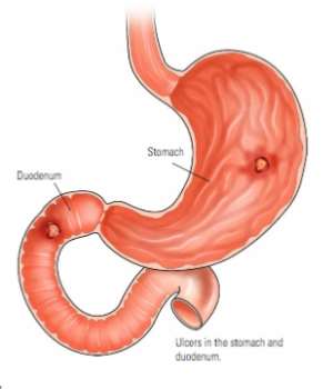 Ulcers, All You Need To Know About Peptic Ulcers