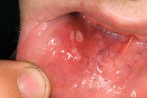 Mouth ulcers, symptoms and how to get rid of them