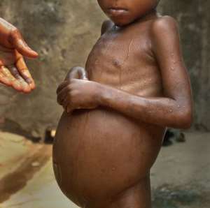 Kwashiorkor still exists among children under five years in Tema Metropolis — Nutritionist