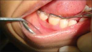 Warm salt water won't cure gum disease - Dentist