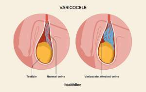 Male Infertility Risk: The importance of diagnosing and treating Varicocele – Expert reveals