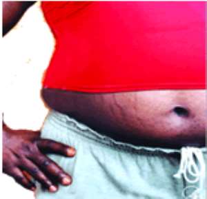 Your stretch marks and you