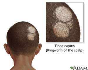 Dermatomycosis, Fungal Skin Infections.