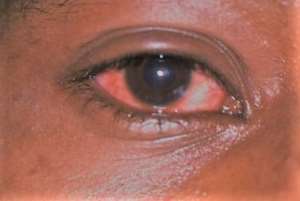 Washing Apollo infected eyes with seawater is inappropriate - Optometrist