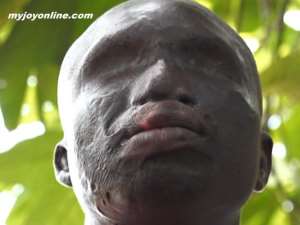 Acid Attack Leaves Night Driver With Daily Nightmare