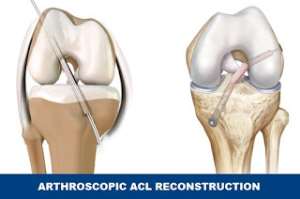 Knee Arthroscopic ACL reconstruction