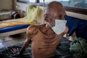 A tuberculosis patient in Africa