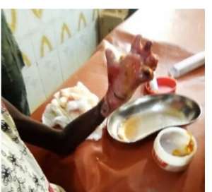 Teacher arrested for dipping hands of 9-year-old girl in hot water for stealing GH2