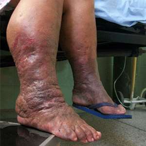 Lymphoedema Is A Disease Condition Not A Curse