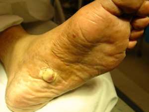 Kaposi's sarcoma under the foot