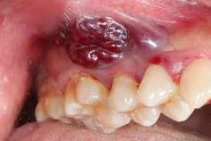 Kaposi's sarcoma tumor in the mouth