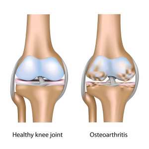 Why is knee arthritis common in India?