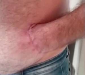 Man whose hand was sewn into abdomen is on the road to recovery