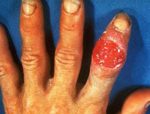 Primary syphilitic infection of the finger